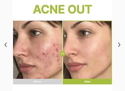Purito Seoul Azelaic Acid 10% Kojic Tea Tree Serum