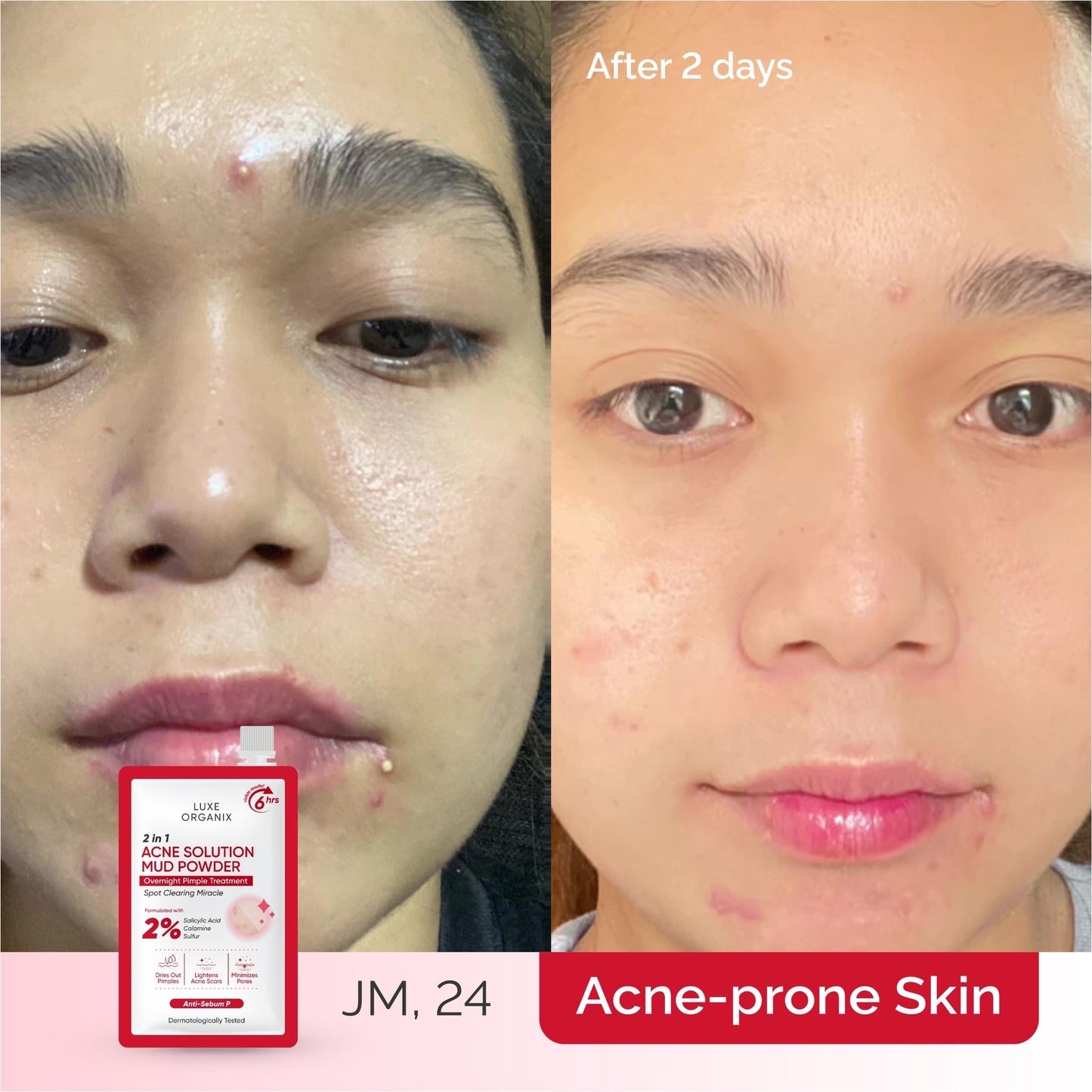 Acne solution mud powder